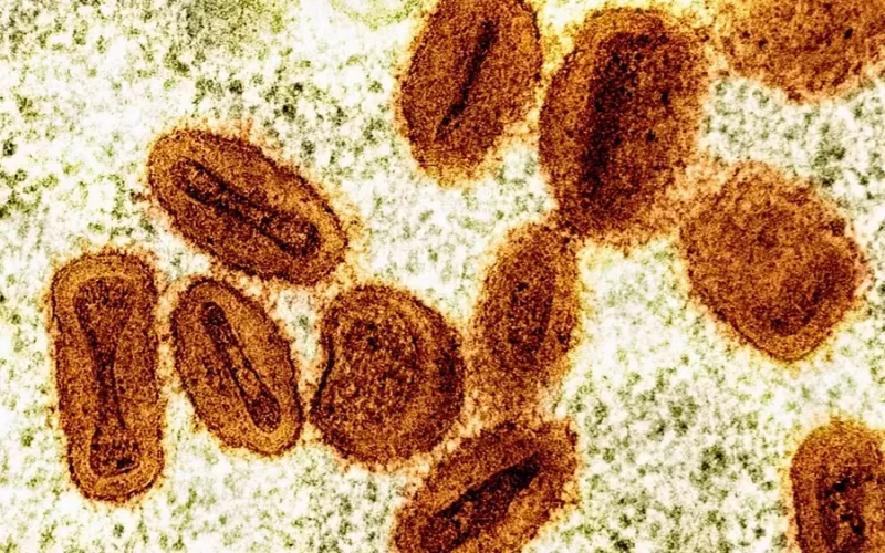 Secretaria de Saúde investiga caso suspeito de mpox em jovem que esteve em João Pessoa