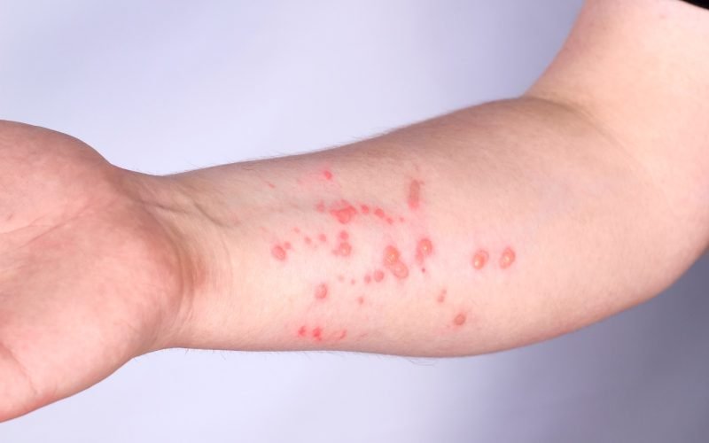 Nova variante da mpox tem maior transmissibilidade e mortalidade, explica infectologista